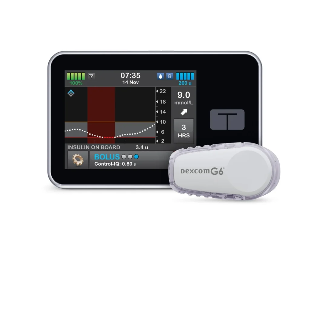 Tandem T + Dexcom G6 continuous glucose monitoring system showing blood glucose trends on display with sensor device