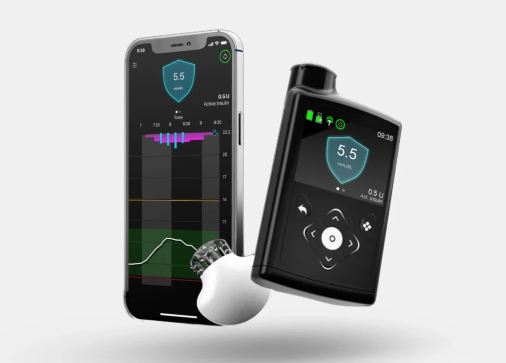 Medtronic Guardian 4 smart insulin pump device with continuous glucose monitoring system and smartphone displaying glucose data
